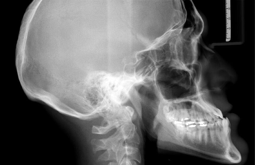 Artificial Intelligence in Radiology